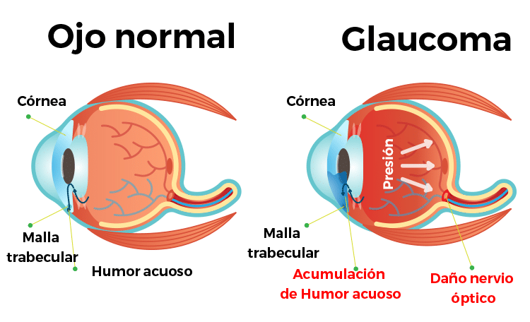 Glaucoma Dra. Paola Zurita Ferrel Oftalmóloga Cochabamba