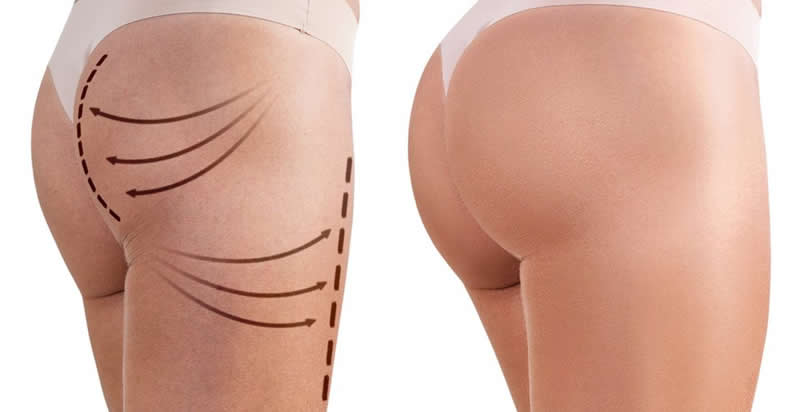 Gluteoplastia - Dr. Diego Armando Morejon Cirujano Plastico