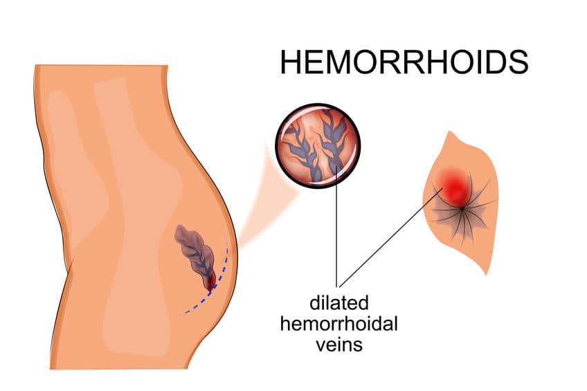 Hemorroides Dr. Jorge Oblitas Medico Internista La Paz