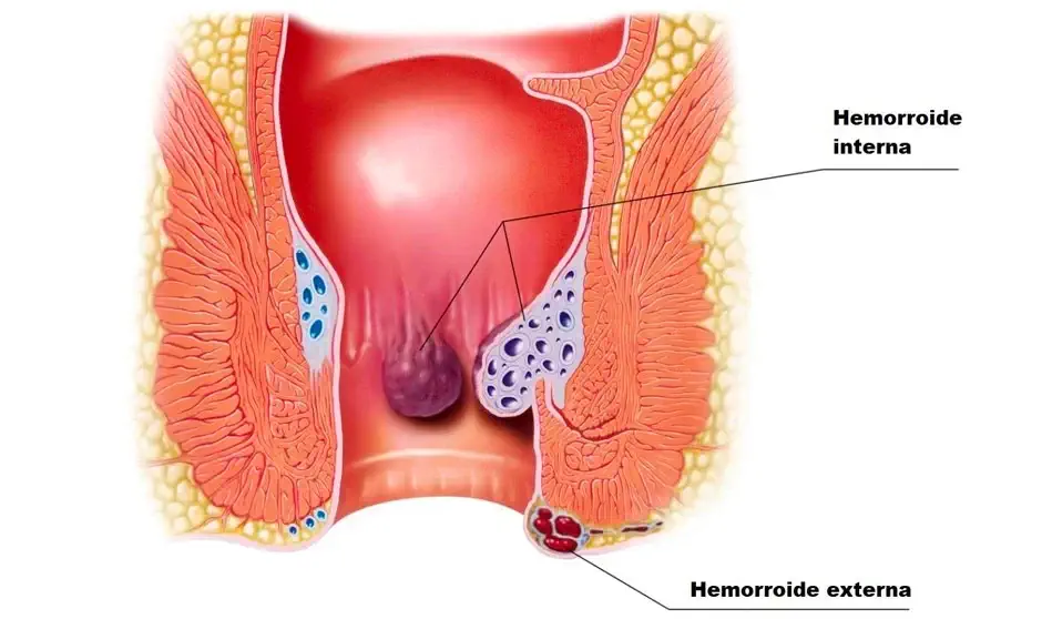 Hemorroides Dra. Alina Gallardo Sejas Cirujana General, Laparoscópica y Coloproctóloga Cochabamba