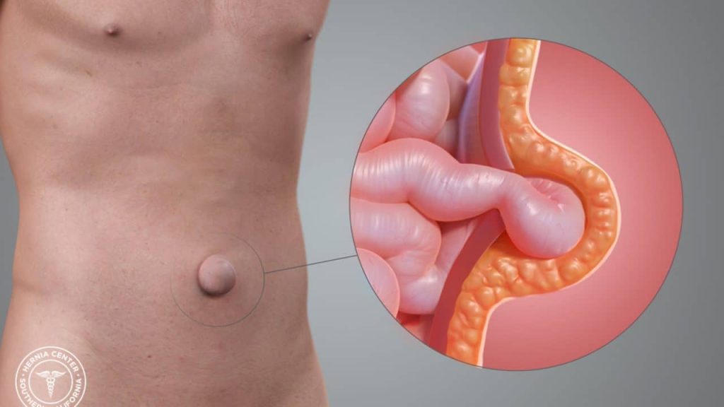 Hernia Dr. Yuri Gil Sabja Cirujano General y Laparoscopia Cochabamba