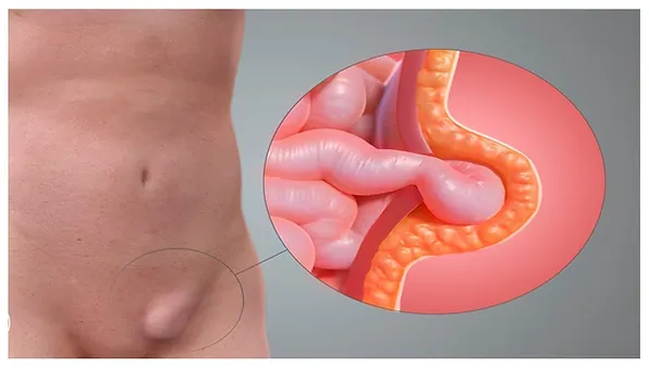 Hernia Inguinal Dr. Yuri Gil Sabja Cirujano General y Laparoscopia Cochabamba