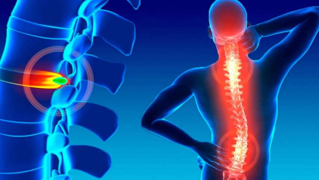 Hernia de Disco Dr. Eduardo Lizarazu Gutierrez Neurocirujano Cochabamba