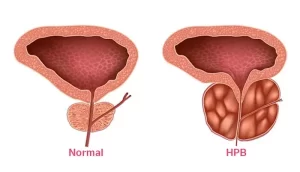 Hiperplasi Prostatica - Dr. Gabriel Valdivia Garron Urologo Cochabamba