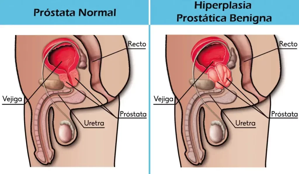Hiperplasia Benigna de Próstata Dr. Roberto Mantilla Mena Urólogo La Paz
