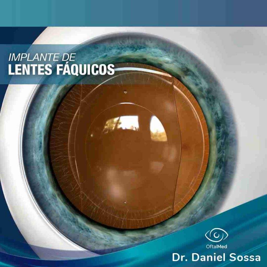 Implante de Lentes Fáquicos Dr. Daniel Sossa Mendez Cirujano Oftalmólogo Cochabamba