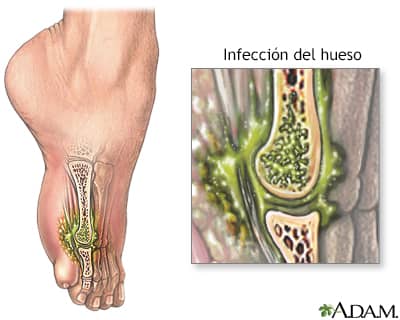 Infección Oseo Articular en Niños Dr. Luis Fernando Murillo Zarate Traumatólogo Pediatra La Paz