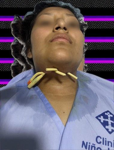 Infecciones Dentales Centro de Cirugía Bucal y Traumatología Maxilofacial en Bolivia