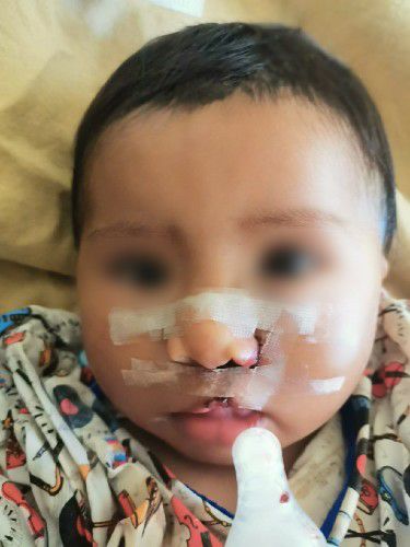Labio y Paladar Fisurados en Pacientes Niños Centro de Cirugía Bucal y Traumatología Maxilofacial en Bolivia