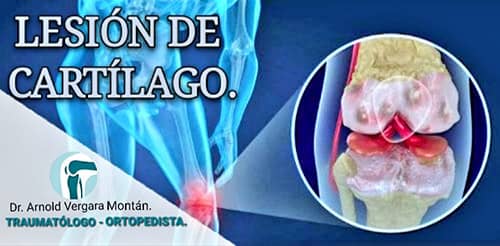 Lesion de Cartilago - Dr. Arnold Vergara Montan - Traumatólogo Ortopedista en cochabamba