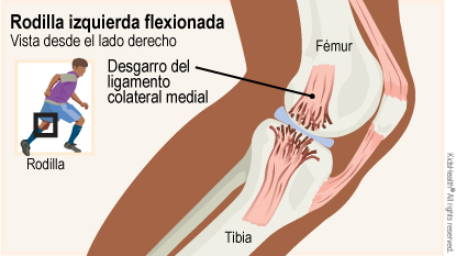 Lesión de Ligamento Colateral Medial Dr. Arnold Vergara Montan Traumatólogo Cochabamba