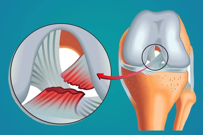 Lesión de Ligamento Cruzado Anteior Dr. Arnold Vergara Montan Traumatólogo Cochabamba