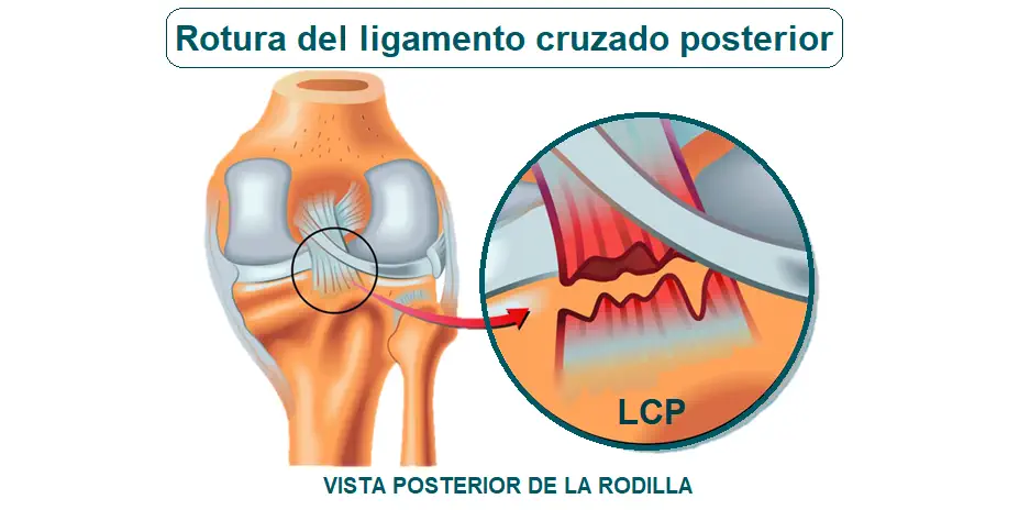 Lesión de Ligamento Cruzado Posterior Dr. Arnold Vergara Montan Traumatólogo Cochabamba