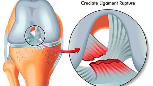 Lesiones Ligamentarias Dr. Arnold Vergara Montán Traumatólogo Cochabamba