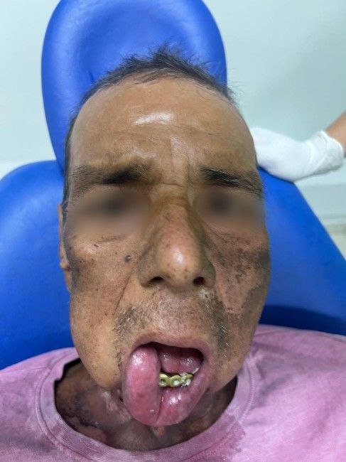 Lesiones Tumorales Malignas Centro de Cirugía Bucal y Traumatología Maxilofacial en Bolivia