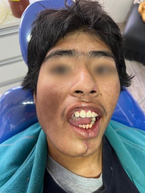 Lesiones Tumorales Malignas Centro de Cirugía Bucal y Traumatología Maxilofacial en Bolivia