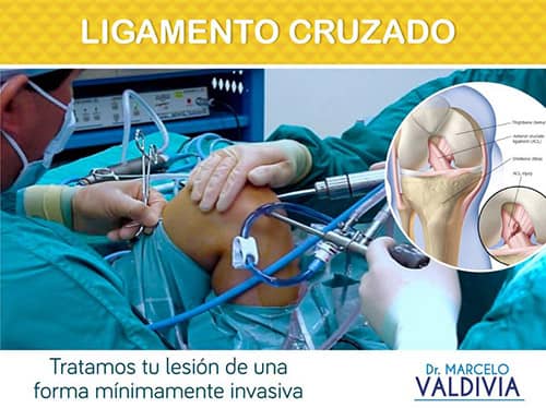 Ligamento Cruzado - Dr. Marcelo Valdivia Loza - Traumatólogo Ortopedista en cochabamba