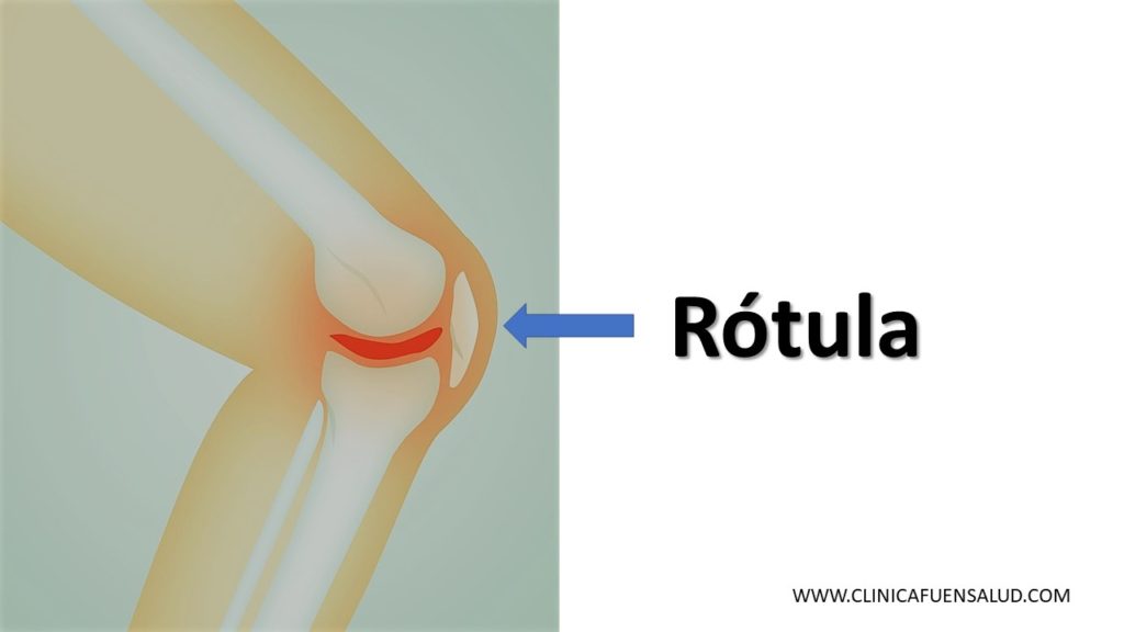 Luxación de Rotula Dr. Arnold Vergara Montan Traumatólogo Cochabamba