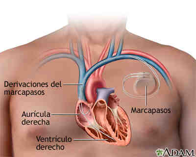 Marcapaso Dr. Carlos Brockmann Cirujano Cardiovascular en Bolivia