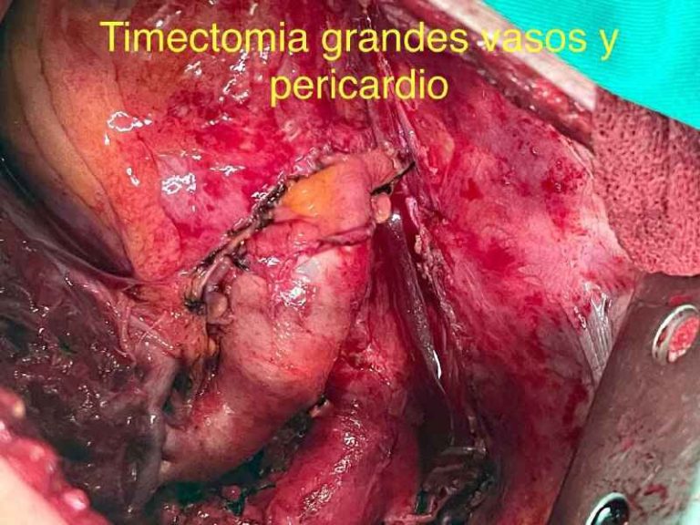 Mediastinitis Dr. Cesar Augusto Angulo Cirujano Torácico Cochabamba