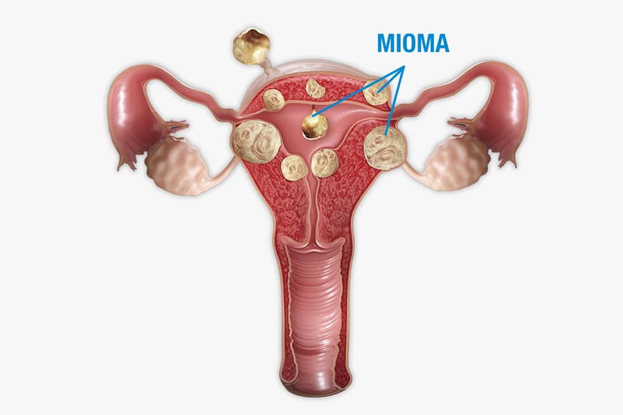 Mioma Dr. Juan Abujder Eid Ginecólogo Obstetra Cochabamba