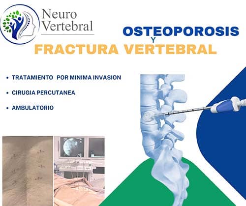 Osteoporosis Dr. Diego Leon Lopez Neurocirujano Cochabamba