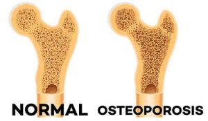 Osteoporosis Dr. Diego Leon Lopez Neurocirujano Cochabamba1