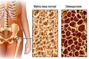 Osteoporosis Dr. Luis Carlos Rodriguez Delgado Reumatólogo Cochabamba