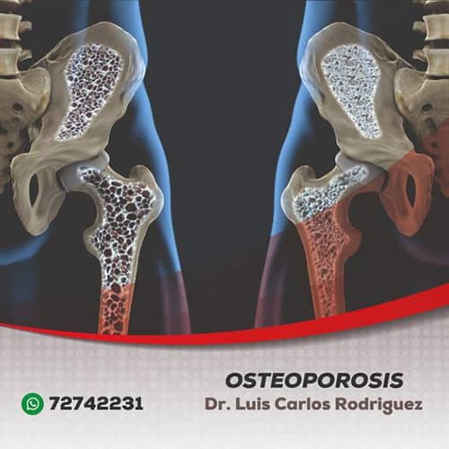 Osteoporosis - Dr. Luis Carlos Rodriguez Delgado – Reumatólogo en Cochabamba