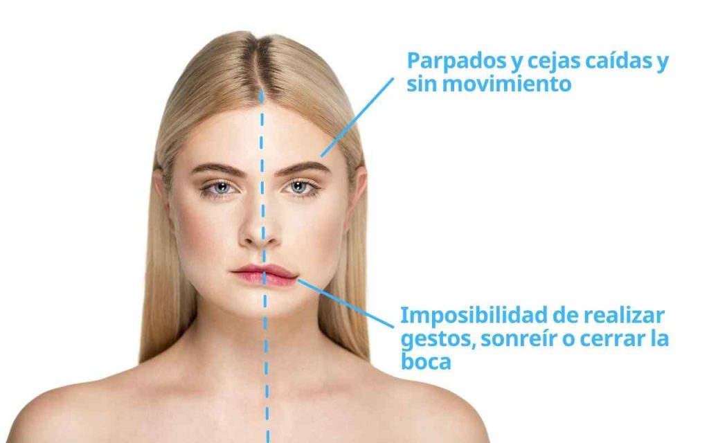 Parálisis Facial Dra. Edna Catherine Serrano Arancibia Neuróloga La Paz