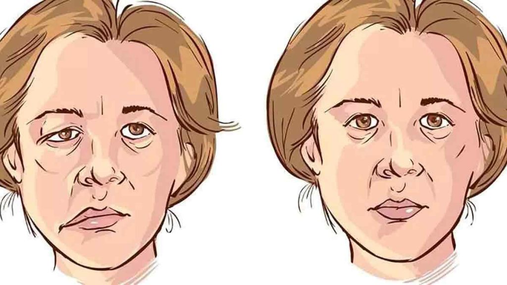 Parálisis Facial Dra. Edna Catherine Serrano Arancibia Neuróloga La Paz