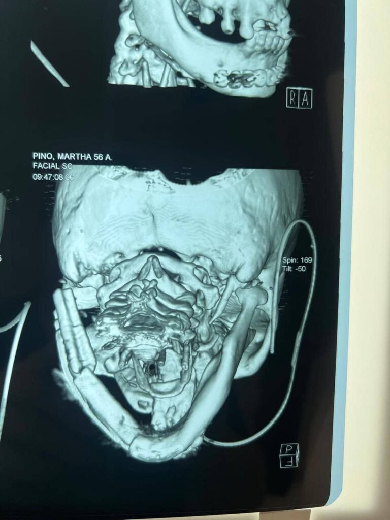 Primera Cirugía Exitosa de Injerto Vascular Doble en Bolivia Centro de Cirugía Bucal y Traumatología Maxilofacial en Bolivia