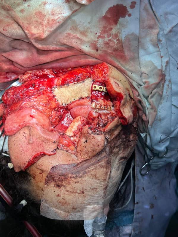 Primera Cirugía Exitosa de Injerto Vascular Doble en Bolivia Centro de Cirugía Bucal y Traumatología Maxilofacial en Bolivia