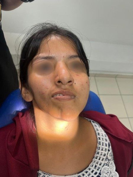 Primera Cirugía Exitosa de Reconstrucción Facial Doble en Bolivia Centro de Cirugía Bucal y Traumatología Maxilofacial en Bolivia