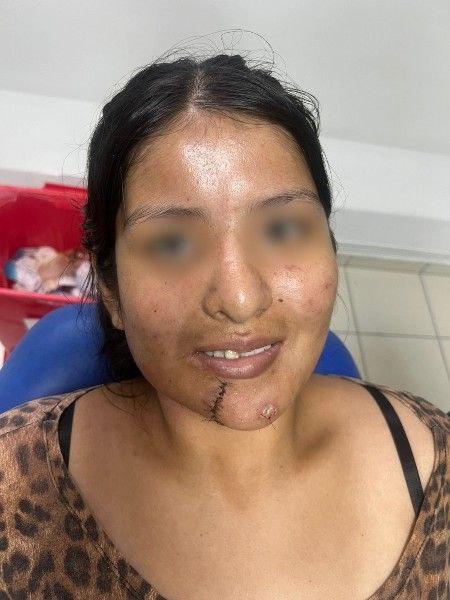 Primera Cirugía Exitosa de Reconstrucción Facial Doble en Bolivia Centro de Cirugía Bucal y Traumatología Maxilofacial en Bolivia