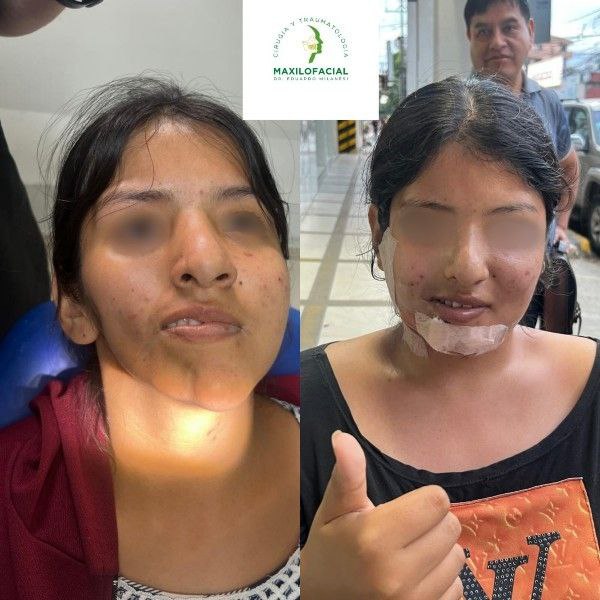 Primera Cirugía Exitosa de Reconstrucción Facial Doble en Bolivia Centro de Cirugía Bucal y Traumatología Maxilofacial en Bolivia