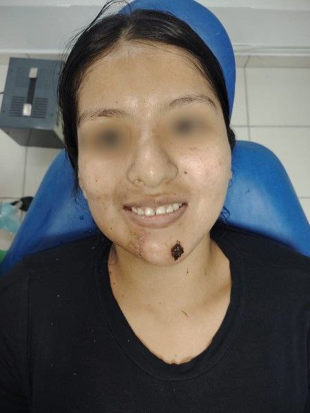 Primera Cirugía Exitosa de Reconstrucción Facial Doble en Bolivia Centro de Cirugía Bucal y Traumatología Maxilofacial en Bolivia