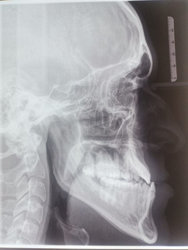 Prognatismo Mandibular Centro de Cirugía y Traumatología Bucomaxilofacial Bolivia