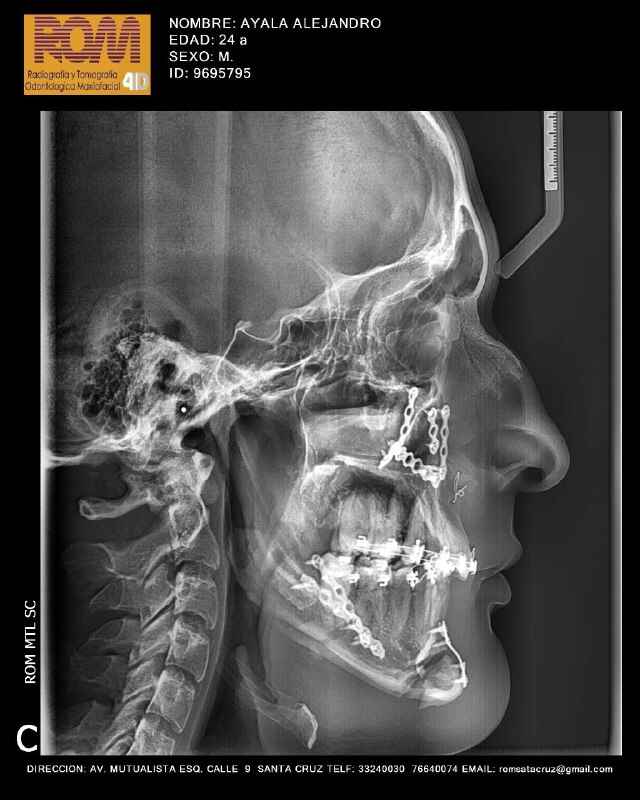 Prognatismo Mandibular Centro de Cirugía y Traumatología Bucomaxilofacial Bolivia