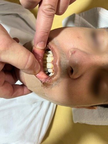 Prognatismo Mandibular Centro de Cirugía y Traumatología Bucomaxilofacial Bolivia