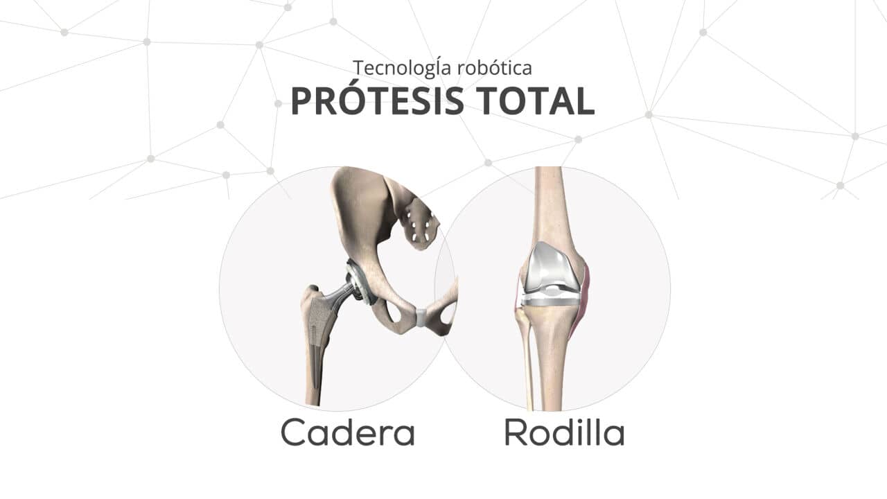 Prótesis de Cadera y Rodilla Dr. Augusto Vinicio Sempértegui Aráoz Traumatólogo Ortopedista en Cochabamba