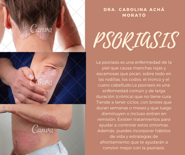 Psoriasis - Dra. Caroloina Acha Morato Dermatologa Cochabamba