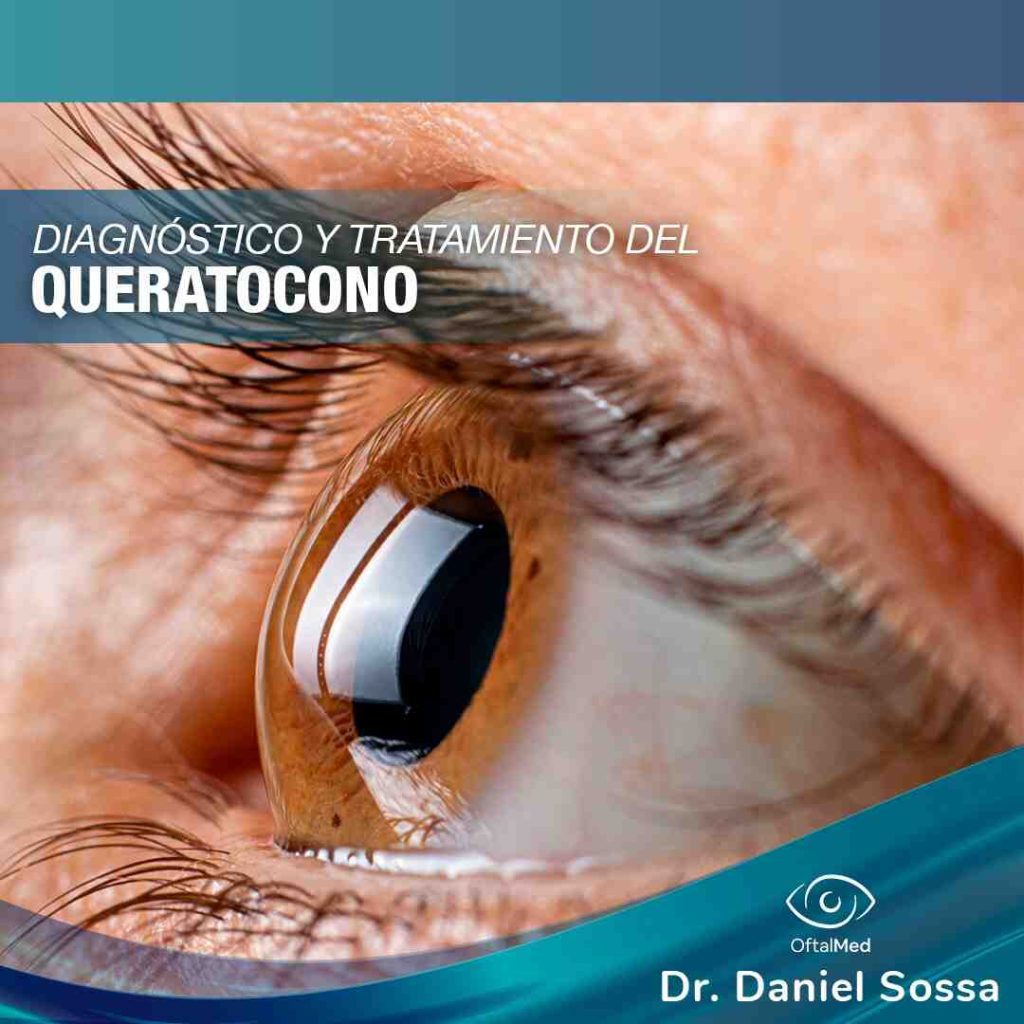 Queratocono Dr. Daniel Sossa Mendez Cirujano Oftalmólogo Cochabamba