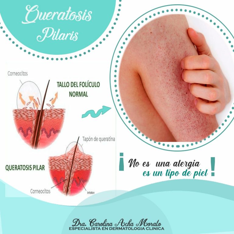 Queratosis Pilaris - Dra. Caroloina Acha Morato Dermatologa Cochabamba
