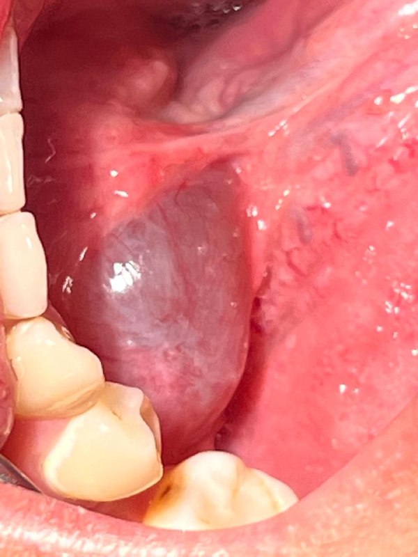 Quiste Centro de Cirugía Bucal y Traumatología Maxilofacial en Bolivia