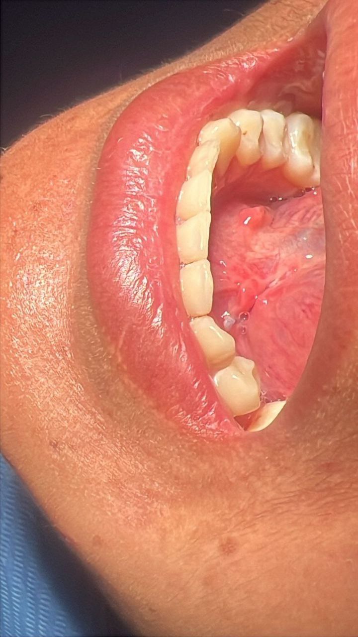 Quiste Centro de Cirugía Bucal y Traumatología Maxilofacial en Bolivia