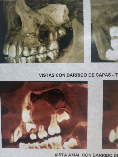 Quistes Dentarios en Niños Centro de Cirugía Bucal y Traumatología Maxilofacial en Bolivia
