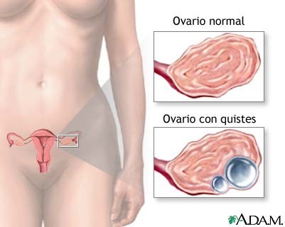 Quistes de Ovario Dr. Edwin H. Veizaga Vargas Ginecólogo Obstetra Cochabamba