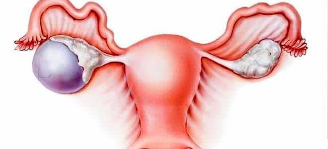 Quistes de Ovario Dr. Juan Abujder Eid Ginecólogo Obstetra Cochabamba