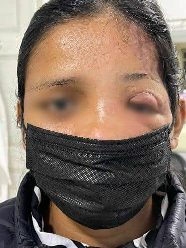 Reconstrucción Facial - Cirujano Maxilofacial Santa Cruz - Centro de Cirugía Bucal y Traumatología Maxilofacial en Bolivia